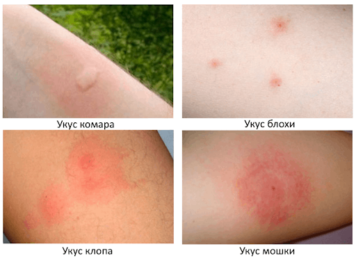 На фото описано про укусы насекомых